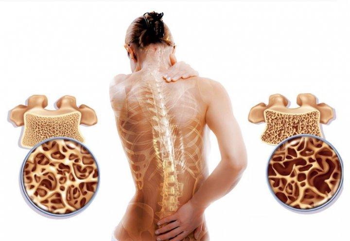 osteoporoz